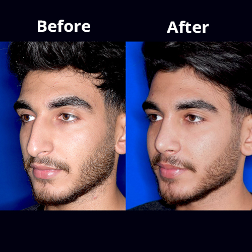 تصاویر قبل و بعد از عمل زیبایی بینی