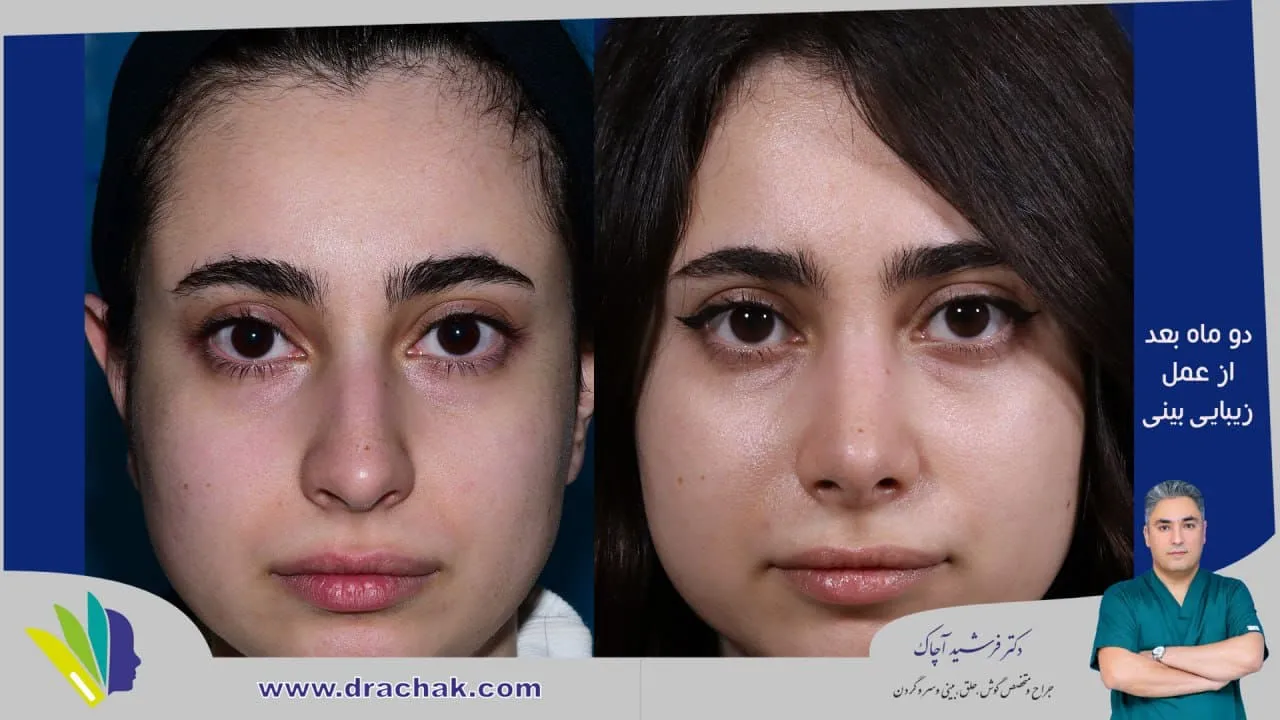 نمونه جراحی بینی دکتر آچاک