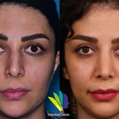 تصاویر قبل و بعد از جراحی زیبایی بینی توسط دکتر فرشید آچاک