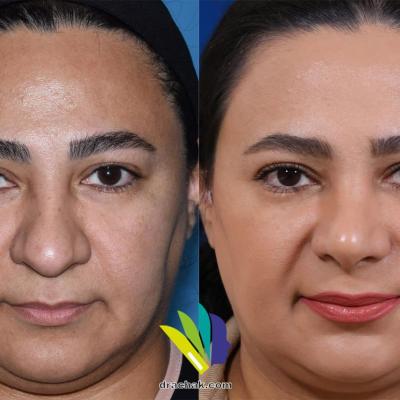 تصاویر قبل و بعد از عمل جراحی بینی