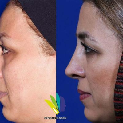 تصاویر قبل و بعد از جراحی زیبایی بینی