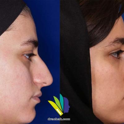 تصاویر قبل و بعد از جراحی زیبایی بینی
