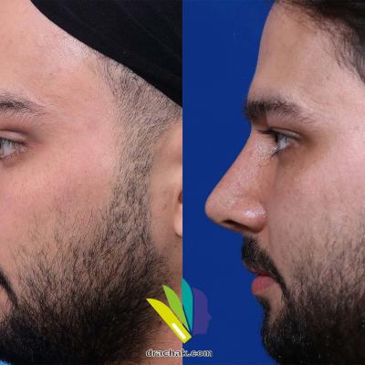 تصاویر قبل و بعد از عمل زیبایی بینی توسط دکتر فرشید آچاک